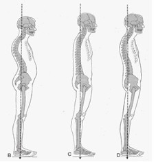 Bad spine alignment
